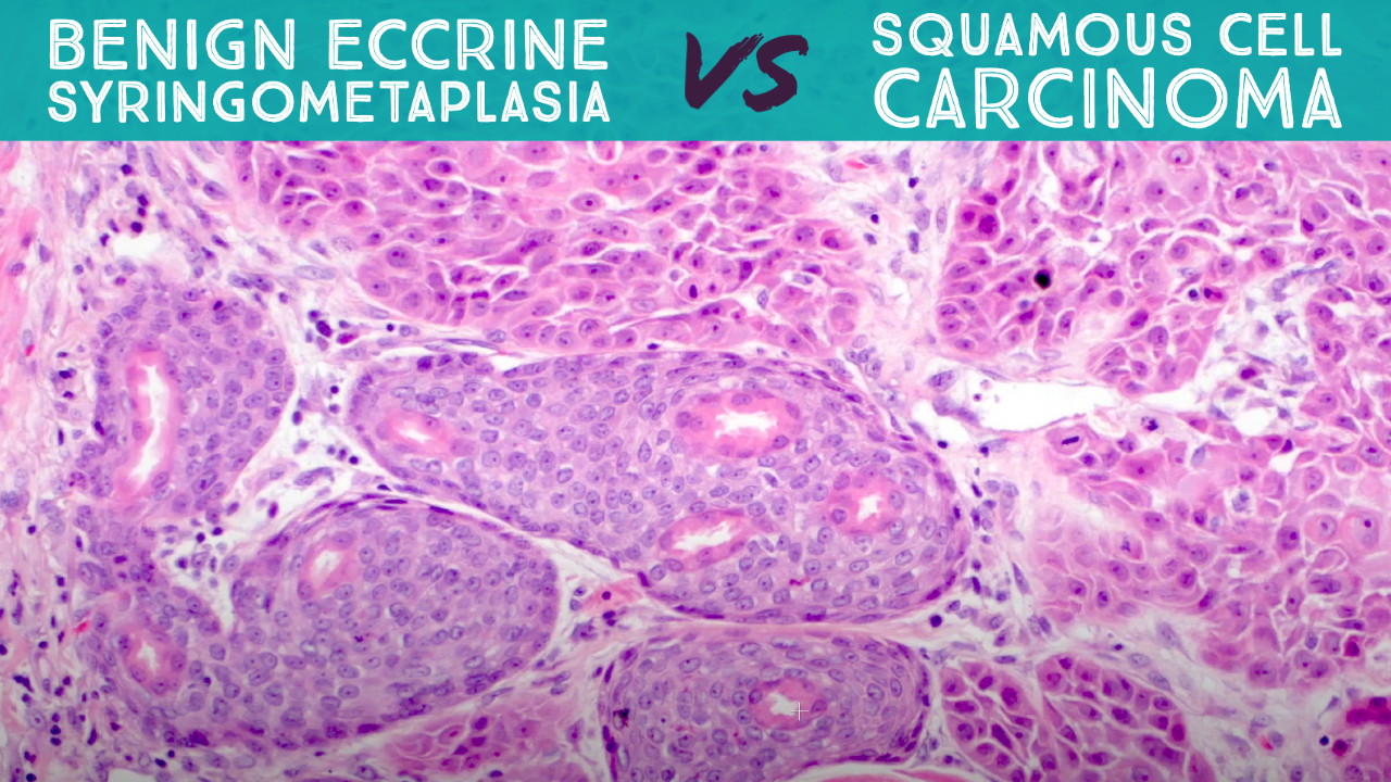 Average Size Of Squamous Cell Carcinoma